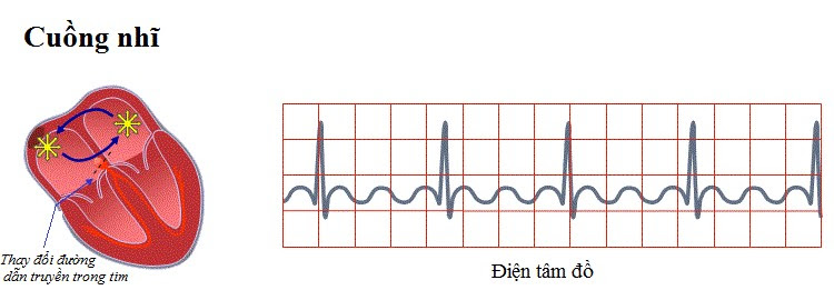 Atrial Flutter - Hình ảnh minh họa